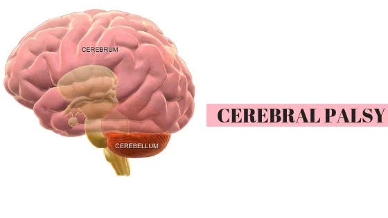 Cerebral palsy (CP) is a condition in which a number of neuromuscular abnormalities result from damage to the brain at an early stage of development.